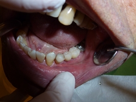 Оферти за Dental Implants 12