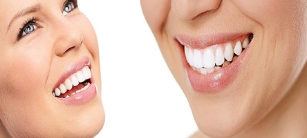 Ефектни избелване на зъби 1
