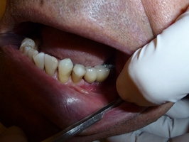 Ефектни избелване на зъби 2