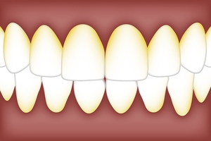Разгледайте избелване на зъби 33