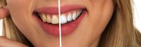 Намерете най-добрите оферти за Поставяне на фасети софия 10 от The Smile Company Намерете най-добрите оферти за Поставяне на фасети софия 10