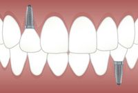 Намерете най-добрите оферти за Зъбни импланти 44