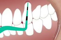 алайнери - 28300 отстъпки | Medicaldent алайнери - 12663 отстъпки