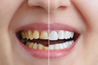 Invisalign - 27539 предложения | Medicaldent Invisalign - 20834 предложения