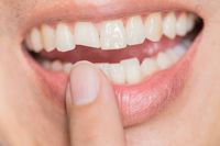 Invisalign - 1192 промоции Invisalign - 65035 промоции