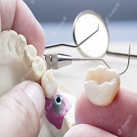 циркониева коронка цена - 75736 постижения | Дентимплант циркониева коронка цена - 20485 постижения