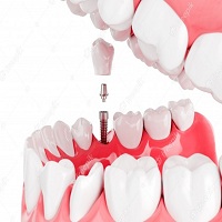 циркониева коронка цена - 63543 варианти циркониева коронка цена - 8773 варианти