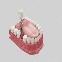 циркониева коронка цена - 45792 снимки циркониева коронка цена - 51731 снимки