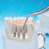 циркониева коронка цена - 22989 новини циркониева коронка цена - 50489 новини