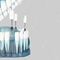 видове зъбни импланти - 22904 варианти видове зъбни импланти - 92771 варианти