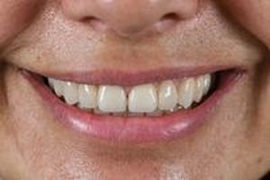 бондинг на зъби - 91836 комбинации | Supreme Dental бондинг на зъби - 26889 комбинации