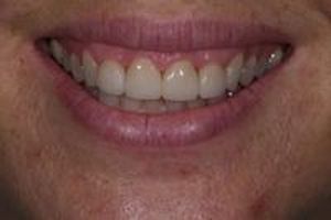 зъбни фасети - 83679 разновидности | Supreme Dental зъбни фасети - 6771 разновидности
