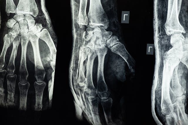 костна плътност - 57278 разновидности | osteostrong.bg костна плътност - 65781 разновидности